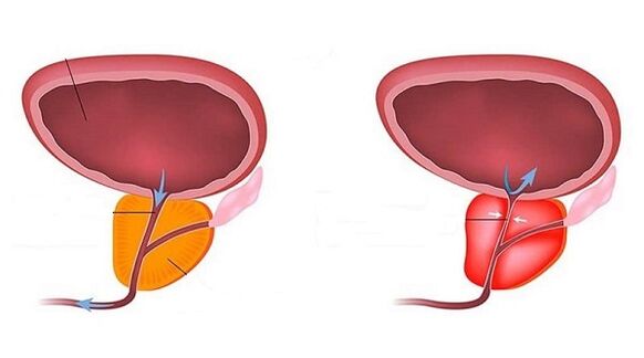 Healthy and inflammatory prostate with prostatitis